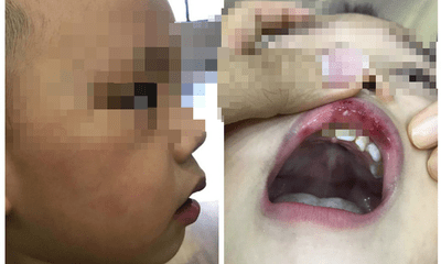 Diễn biến mới nhất vụ cô giáo tát trẻ 3 tuổi bầm tím mặt, tụ máu môi