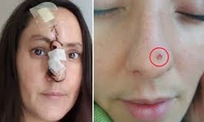 Nghiện làm đẹp da, người phụ nữ bị cắt mất một đoạn mũi