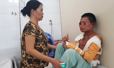 Xui rủi ập đến, nam sinh bất ngờ bị bỏng nặng trước ngày thi THPT quốc gia