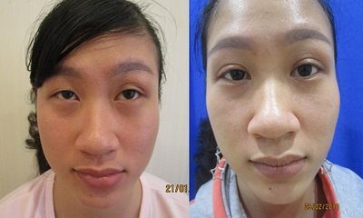 Nguyên nhân và cách chữa sụp mí mắt hiệu quả đến 99% cho người Việt