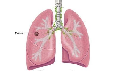 Bệnh ung thư phổi có mấy loại, mấy giai đoạn?