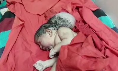 Ấn Độ: Bác sĩ sốc khi thấy bé gái sơ sinh có ba đầu