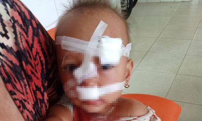 Quảng Bình: Xót xa bé gái 2 tuổi nhập viện, khâu 12 mũi trên mặt do bố mẹ mâu thuẫn