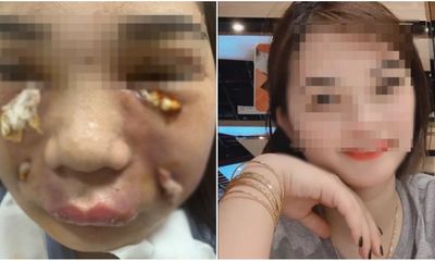 Sau một ngày tiêm mỡ tự thân vào mặt, cô gái trẻ phải nhập viện khẩn cấp vì nhiễm trùng