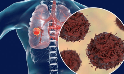 U phổi – Căn bệnh có xu hướng ngày càng tăng nhanh trên toàn cầu 