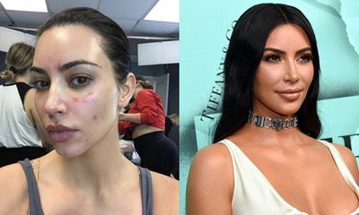 Kim Kardashian đăng ảnh cận mặt lấm tấm vết đỏ vì vảy nến