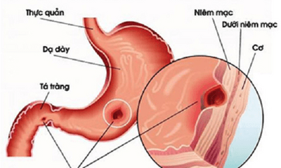 Viêm loét dạ dày – Nguyên nhân trực tiếp gây ung thư