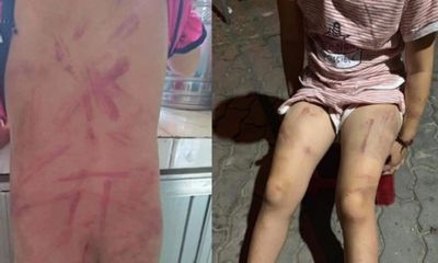 Quảng Nam: Làm rõ nghi vấn bé gái 6 tuổi bị bà đánh đập gây thương tích đầy mình