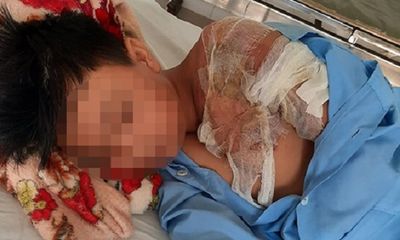 Điều tra vụ cha tạt nước sôi khiến con trai 11 tuổi bị bỏng nặng ở Long An