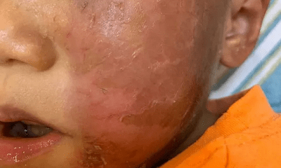 Bác sĩ nói gì sau vụ hóa trang Halloween, bé trai 4 tuổi bị bỏng rộp da mặt