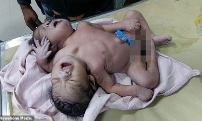 Sản phụ chết ngất khi nhìn thấy con đứa con chào đời có 2 đầu 3 tay