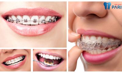 Giải đáp nha khoa: Răng đã bọc sứ có niềng được không?