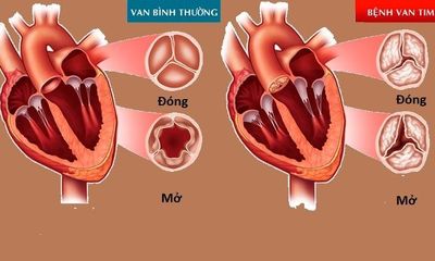 Hẹp hở van tim khó tránh khỏi biến chứng suy tim, loạn nhịp tim 
