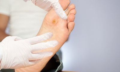 BoniDiabet – Giải pháp phòng biến chứng cắt cụt chân ở bệnh nhân tiểu đường 