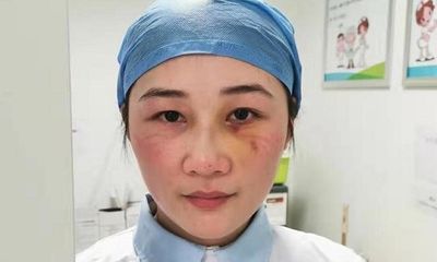 Ngã gãy sống mũi vì làm việc kiệt sức, nữ y tá Vũ Hán vẫn quyết tâm ở lại tuyến đầu tiếp tục chống dịch