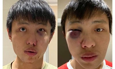Hé lộ hình ảnh kẻ đánh du học sinh người Singapore bầm dập, gẫy xương mặt vì virus Covid-19