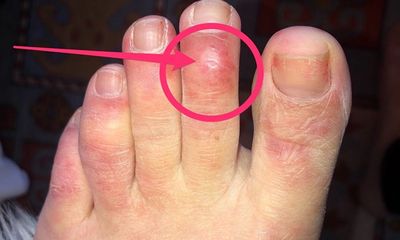 Ngón chân bị sưng có thể là triệu chứng mới của bệnh nhân mắc Covid-19