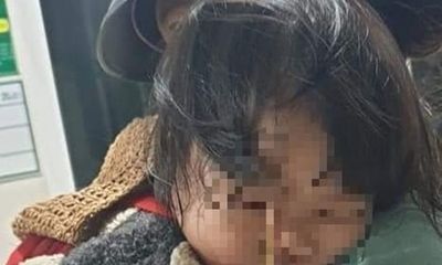Gia Lai: Bé gái 3 tuổi bị que kem đâm vào hốc mắt vì vừa ăn vừa chạy nhảy