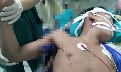 Phẫu thuật thành công cho nam thanh niên bị thanh sắt đâm từ nách lên vai