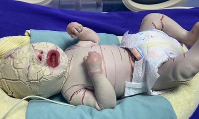 Quảng Ninh: Bé sơ sinh mắc bệnh hiếm gặp, vảy trắng bao bọc toàn thân