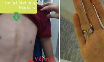 Bé trai 11 tuổi ở Hà Nội cao 1m80 vì căn bệnh hiếm, cha mẹ cần lưu ý con khi thấy lớn bất thường
