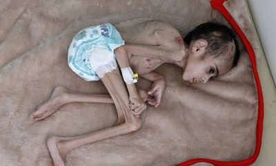 Xót xa hình ảnh cậu bé 7 tuổi gầy trơ xương, nằm hấp hối vì nạn đói