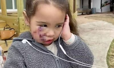 Nhói lòng câu nói của bé gái 3 tuổi sau trận tấn công kinh hoàng của chó pit bull