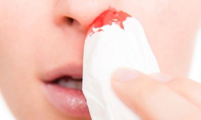 Căn bệnh ung thu vòm họng: Chảy máu cam và những dấu hiệu đặc biệt bị nhiều người xem thường
