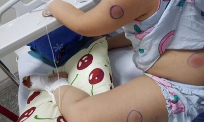 Bị gà mổ gây vết thương ở ngón chân, bé gái nhiễm vi khuẩn 