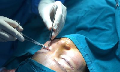 Hà Nội: Đi spa cắt mí, cô gái 23 tuổi bị mù 1 bên mắt