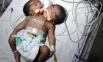 Kỳ lạ bé sơ sinh có hai đầu ở Ấn Độ