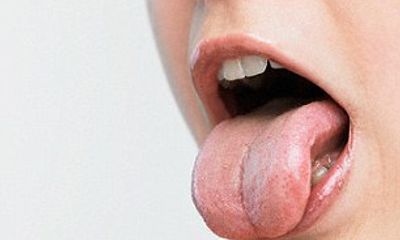 Bắt bệnh qua thay đổi của lưỡi