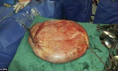 Kỷ lục cắt bỏ khối u nặng gần 25 kg khỏi tử cung 