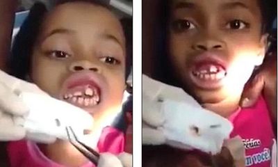 15 con giòi trong miệng bé gái khiến bác sĩ cũng hoảng hốt