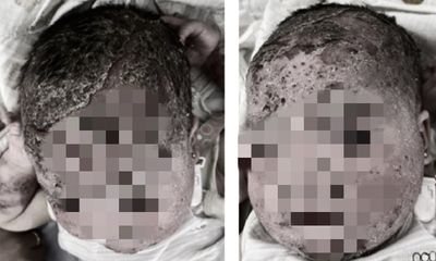  Tắm nhiều loại lá, bé trai 8 tháng tuổi bị nứt da đầu, bong tróc khắp mặt