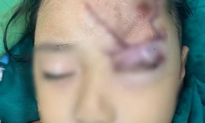 Bé gái 5 tuổi tổn thương vùng mặt nghiêm trọng do bị chó cắn