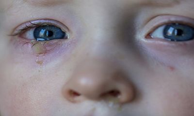 Dịch đau mắt đỏ có chiều hướng gia tăng, cha mẹ cần lưu ý những gì?