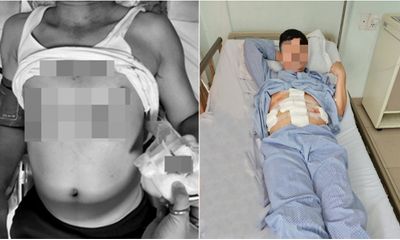 Phẫu thuật thành công cho bệnh nhân bị đạn bắn vết xuyên thấu bụng, đùi