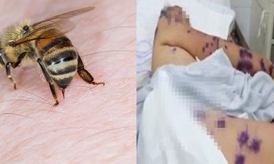 Cấp cứu hai bệnh nhân bị ong đốt hàng trăm nốt khắp cơ thể