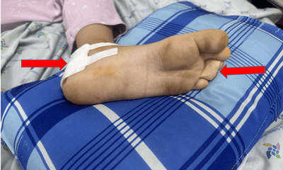 Bé gái 8 tuổi đứt gân gót chân do kẹt vào nan xe máy khi đang chạy