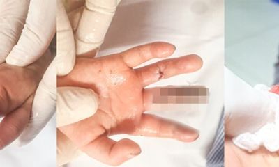 Bệnh nhi 17 tháng tuổi dập ngón tay do máy thêu của gia đình