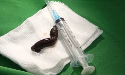 Kinh hoàng phát hiện con đỉa dài 6cm trong cổ họng bệnh nhân 53 tuổi