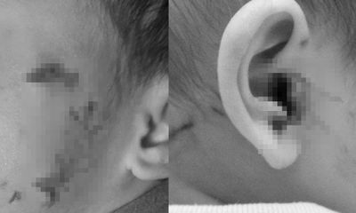 Cấp cứu bé trai 16 tháng tuổi bị chó cắn chảy máu nhiều vùng tai