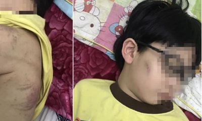 Quảng Ninh: Chính quyền bác thông tin bé trai bị mẹ bạo hành phải nhập viện