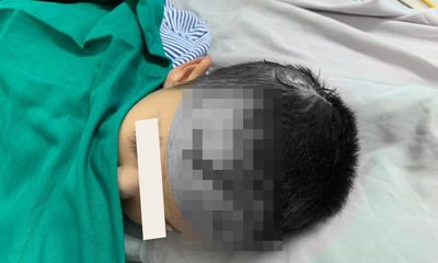 Phú Thọ: Bé trai 2 tuổi bị chó nhà cắn rách da đầu, mặt