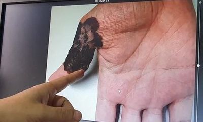 Đời sống - Phát hiện ung thư từ nốt ruồi trên bàn tay