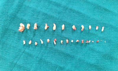 28 chiếc răng dị dạng trong khối u của em bé 9 tuổi