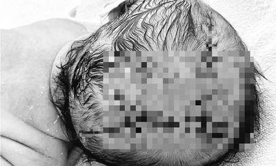 Sai lầm của gia đình khiến bé sơ sinh phải khâu 21 mũi trên đầu