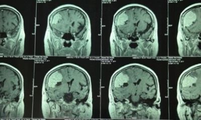 Đau đầu kéo dài, người phụ nữ đi khám thì phát hiện khối u màng não to hơn trứng vịt