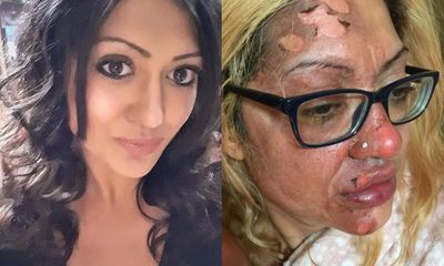 Cộng đồng mạng - Người phụ nữ bị bỏng nặng ở mặt chỉ vì bắt chước theo trend Tik Tok